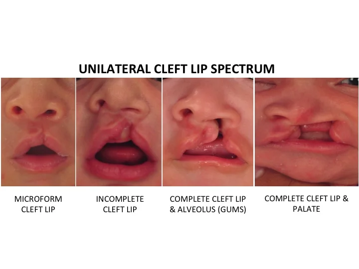 Unilateral Cleft Lip and Palate — Dallas Plastic Surgeon specializing