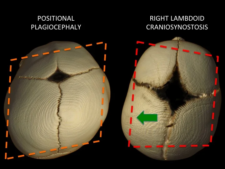 positional plagiocephaly