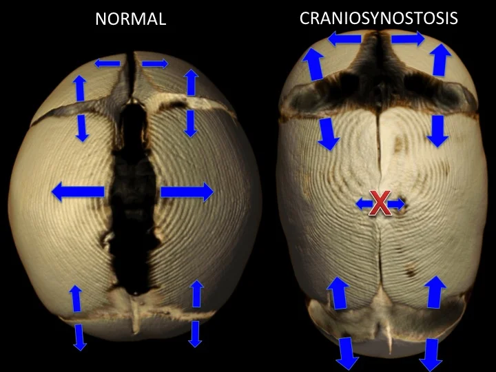Isolated Craniosynostosis — Dallas Plastic Surgeon, Pediatric and Adult