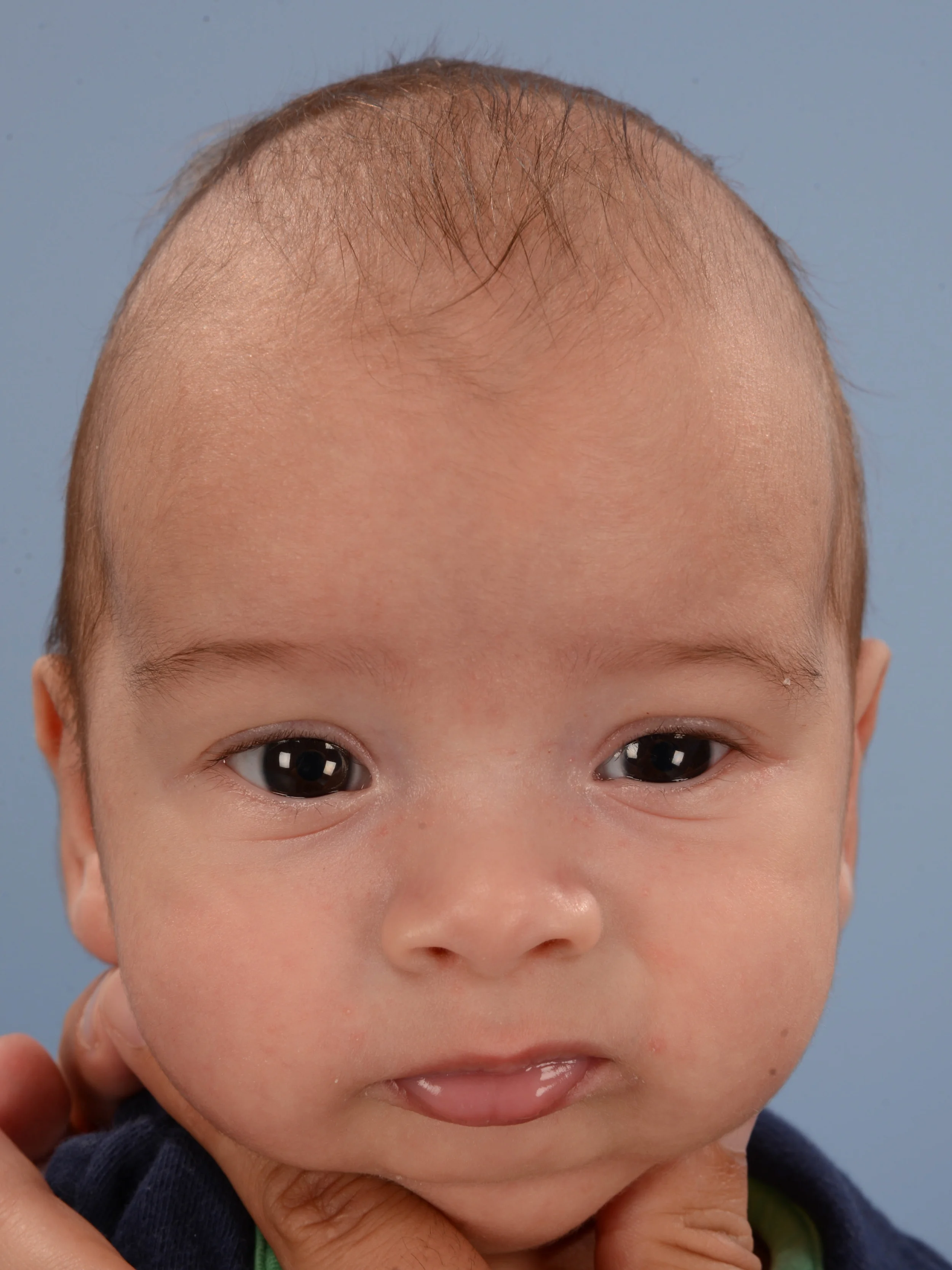 Sagittal Synostosis Scaphocephaly Dallas Plastic Surgeon Specializing In Rhinoplasty Septoplasty Cleft Rhinoplasty Cleft Lip Revision And Ear Surgery