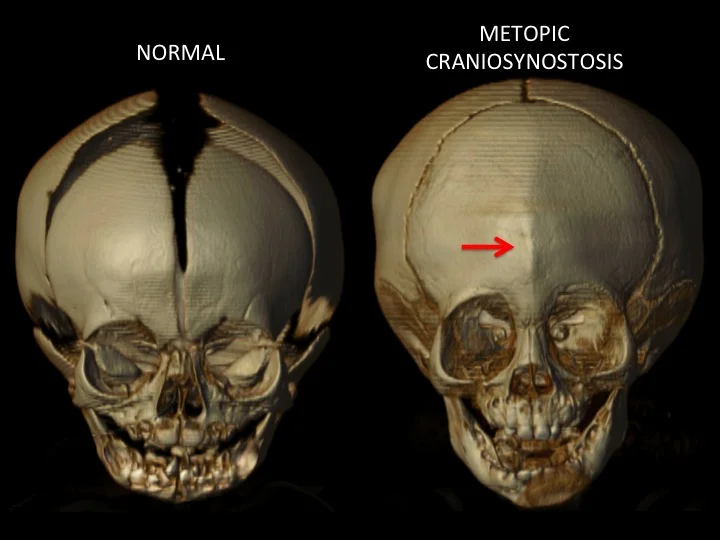 Metopic Synostosis (Trigonocephaly) — Dallas Plastic Surgeon