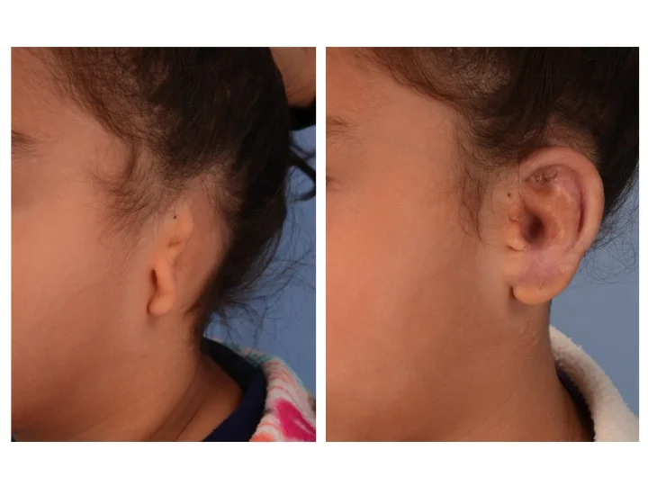Ear Reconstruction (Microtia) — Dallas Pediatric Plastic Surgeon