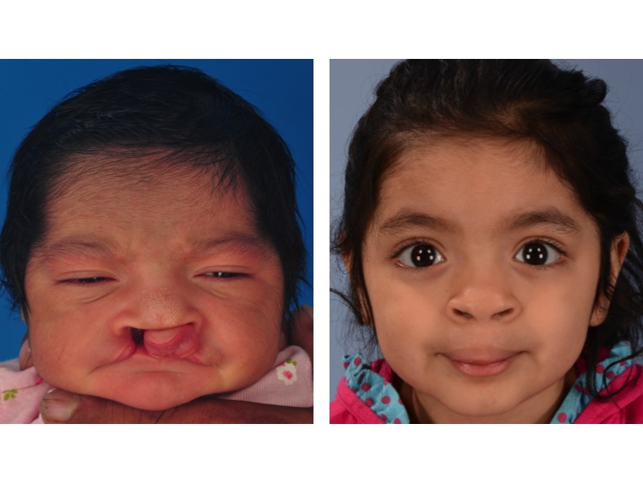 drderderian.com Bilateral Cleft Lip Repair Case 2 AP