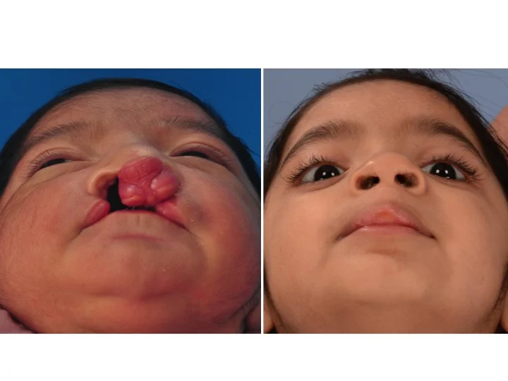 drderderian.com Bilateral Cleft Lip Repair Case 2 Below View