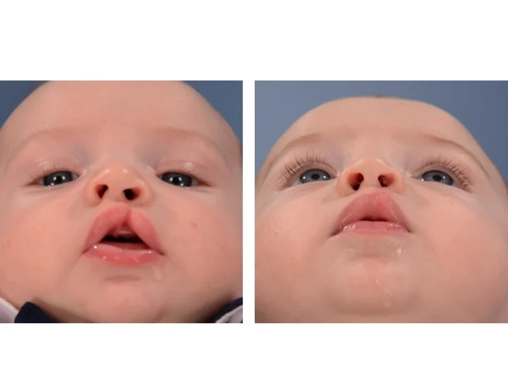 drderderian.com Cleft Lip Repair Case 4 Below View
