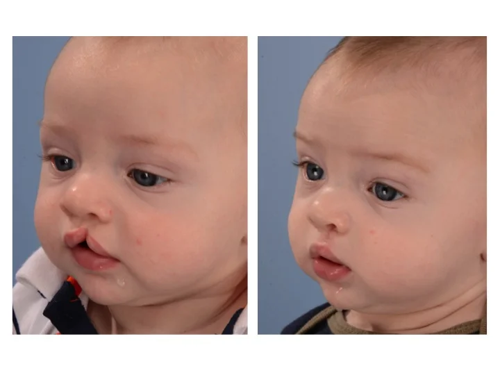 drderderian.com Cleft Lip Repair Case 4 Left 3/4 View