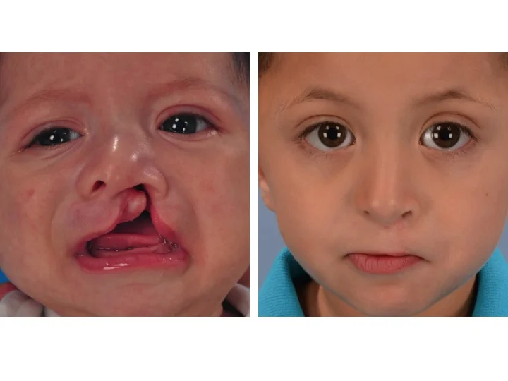 drderderian.com Cleft Lip Repair Case 8 AP close