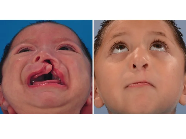 drderderian.com Cleft Lip Repair Case 8 Below View