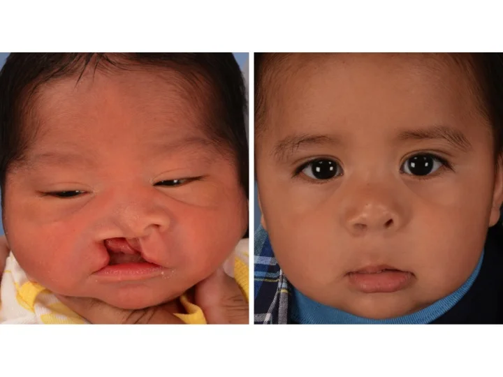 drderderian.com Cleft Lip Repair Case 10 AP