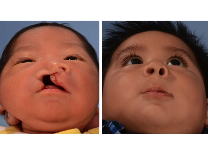 drderderian.com Cleft Lip Repair Case 10 Below View