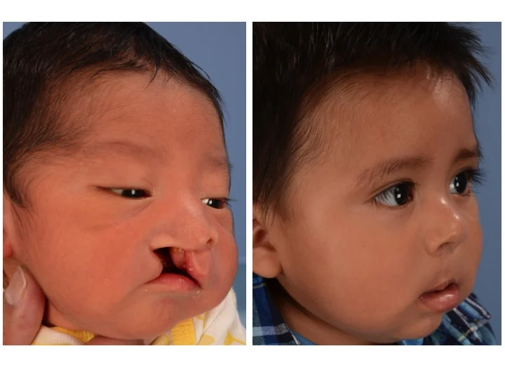drderderian.com Cleft Lip Repair Case 10 3/4 View