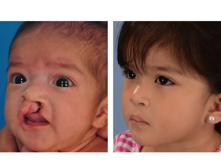 drderderian.com Cleft Lip Repair Case 11 3/4 View