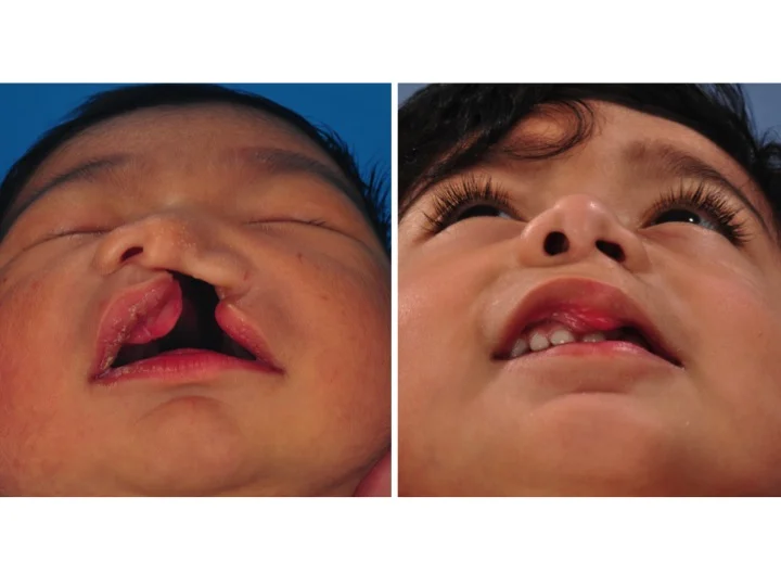 drderderian.com Cleft Lip Repair Case 12 Below View