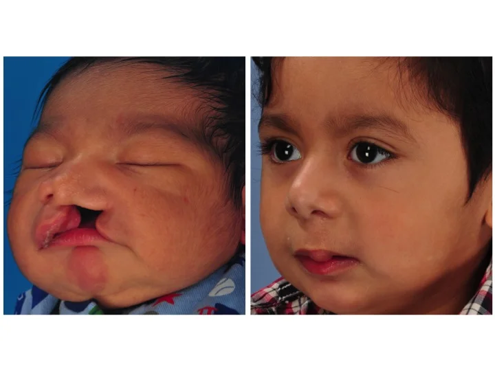 drderderian.com Cleft Lip Repair Case 12 3/4 View