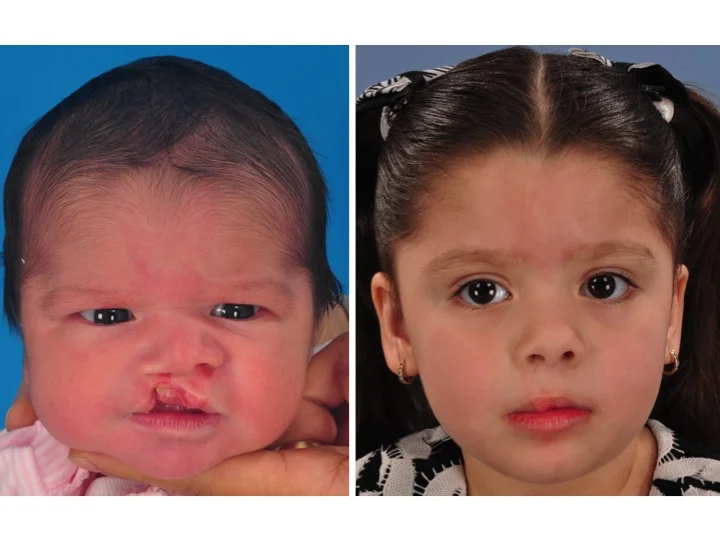 drderderian.com Cleft Lip Repair Case 7 AP