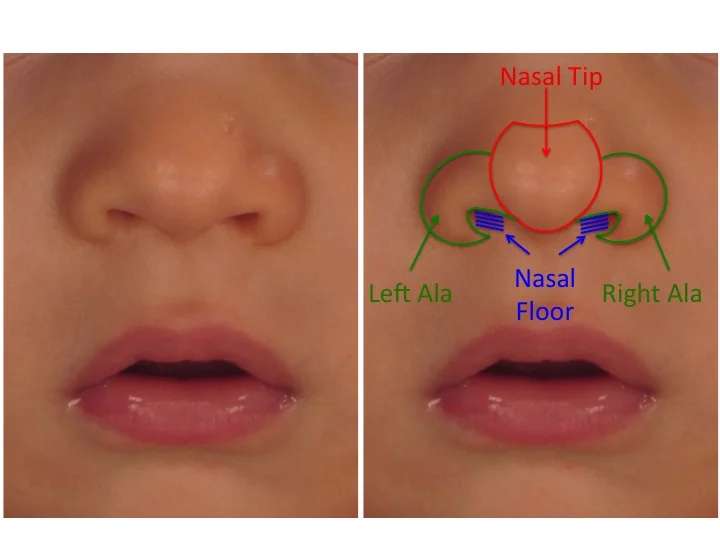 Cleft In Nose Heritage , Secondary Rhinoplasty for Unilateral Cleft ...