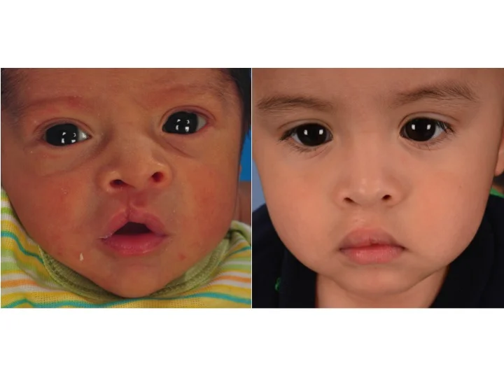 drderderian.com Cleft Lip Repair Case 13 AP close