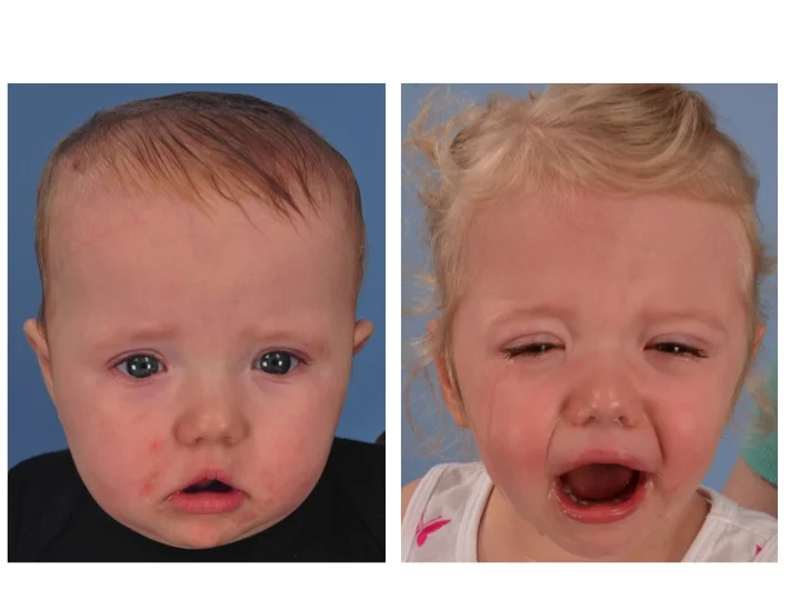 Coronal Synostosis Dallas Pediatric Plastic Surgeon