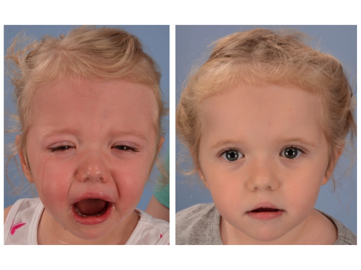 Coronal Synostosis Dallas Pediatric Plastic Surgeon