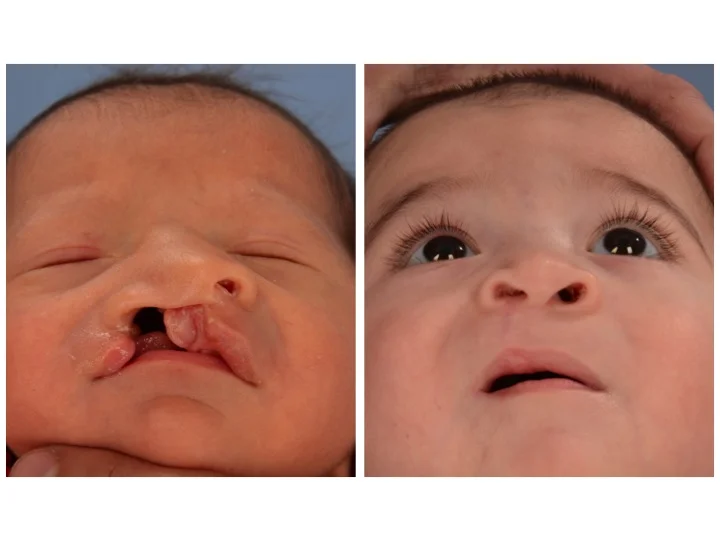 drderderian.com Cleft Lip Repair Case 5 Below View