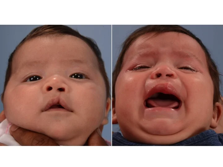 drderderian.com Cleft Lip Repair Case 9 Below View