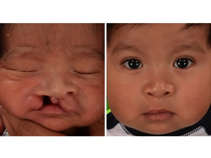drderderian.com Cleft Lip Repair Case 6 AP close