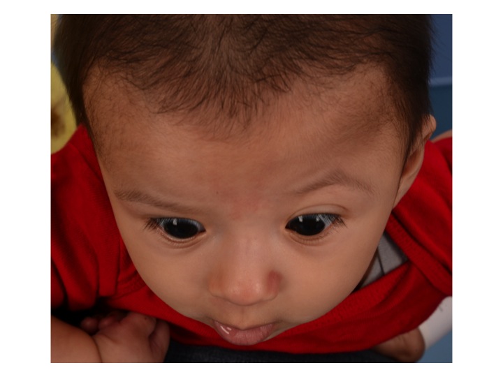 The image above shows the top down view of the same infant with left coronal craniosynostosis. Note that the forehead is flattened on the left and pushed forward on the right.