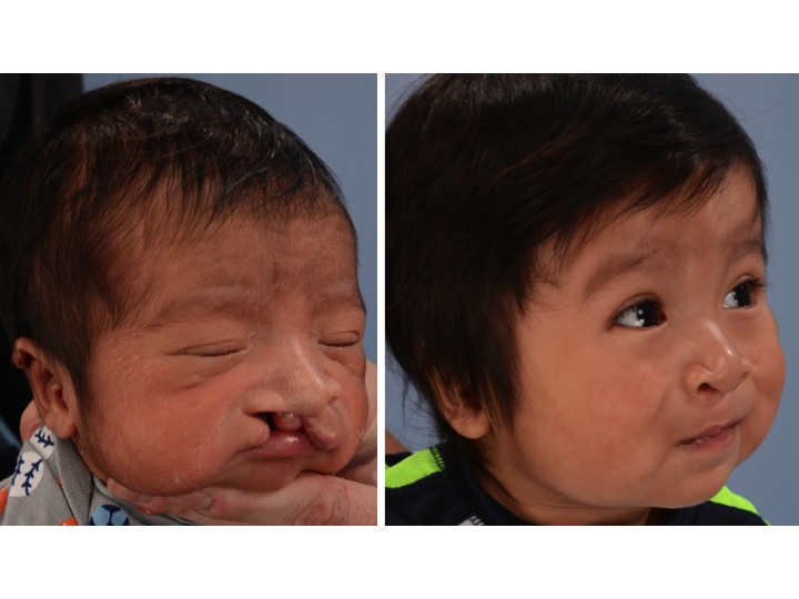 drderderian.com Cleft Lip Repair Case 6 Left 3/4 View