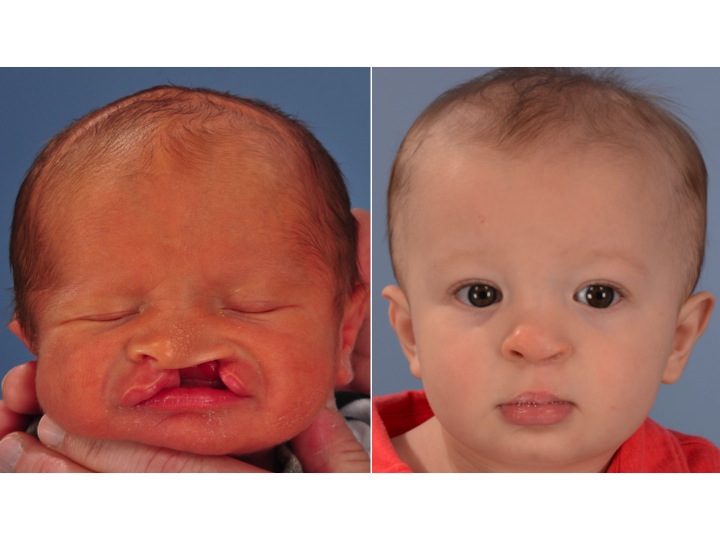drderderian .com Cleft Lip Repair Case 1 AP