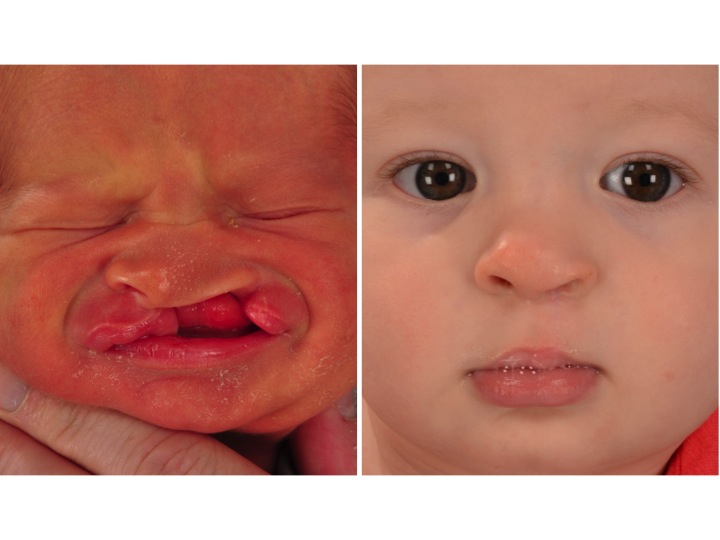 drderderian.com Cleft Lip Repair Case 1 AP Crop