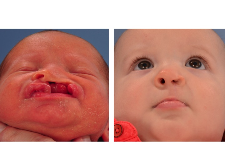 drderderian.com Cleft Lip Repair Case 1 Below view