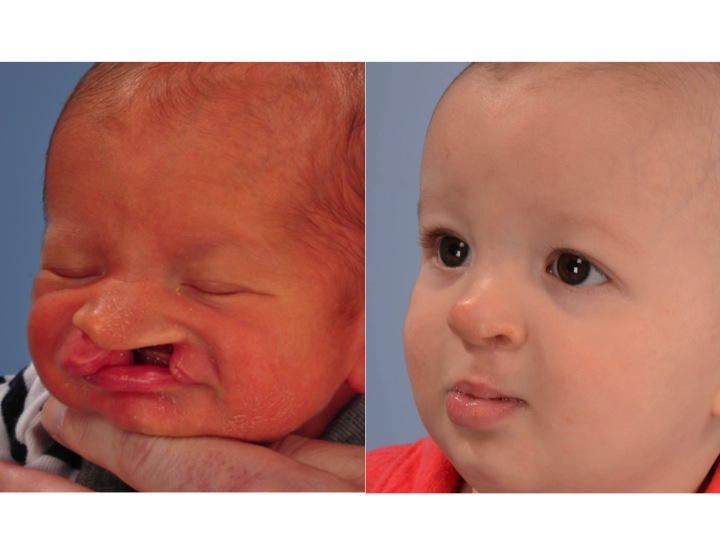 drderderian.com Cleft Lip Repair Case 1 Left 3/4 View