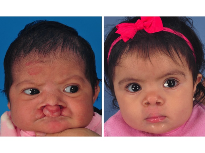 drderderian.com Bilateral Cleft Lip Repair Case 1 AP