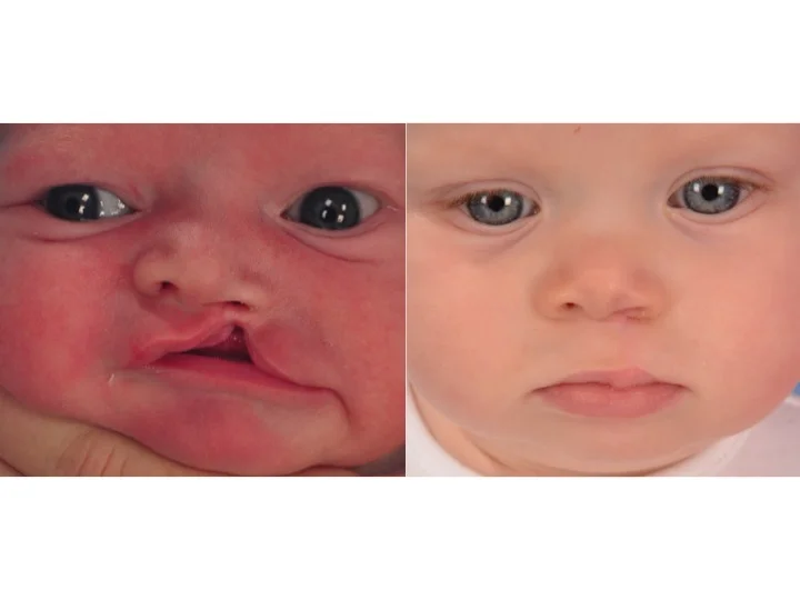 drderderian.com Cleft Lip Repair Case 2 AP Crop