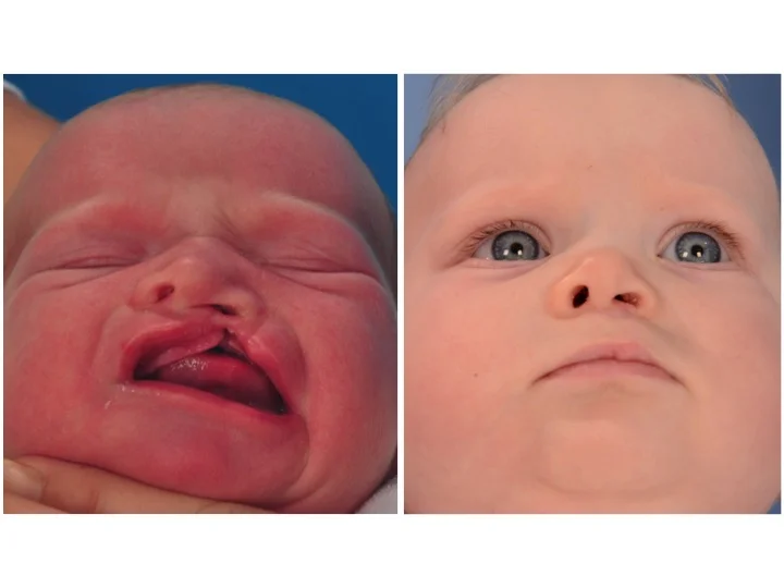 drderderian.com Cleft Lip Repair Case 2 Below View