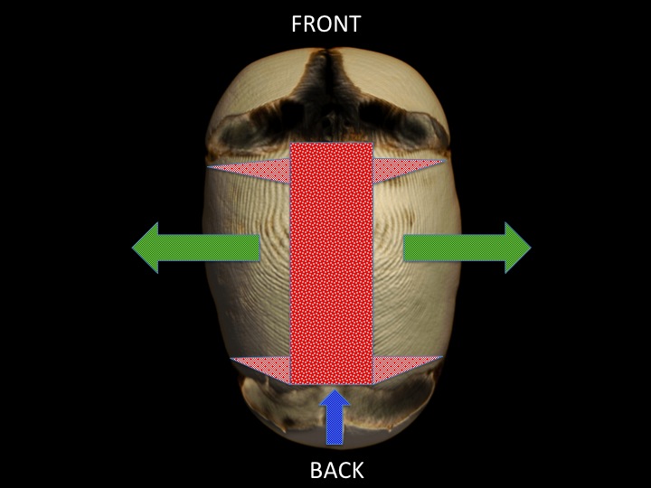 The above image shows the top down view of the same patient's skull. Again, the central dark red area shows the wide sagittal strip craniectomy. The lighter red triangles extend down to the squamosal suture. These bone excisions allow the bone flaps to hinge on the flexible squamosal sutures and widen the skull indicated by green arrows. As the side bone flaps (parietal bones) move outward the back portion of the skull rotates up and forward like a drawbridge opening.