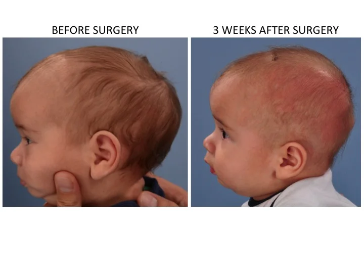 Minimally Invasive (Endoscopic) Sagittal Strip Craniectomy — Dallas