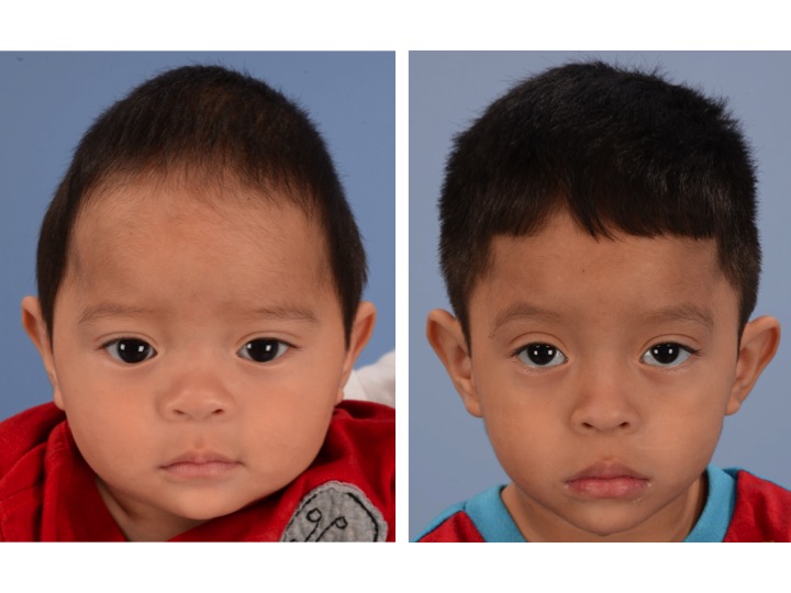 The picture on the left shows a boy with significant narrowing of the back portion of the skull and significant compensatory growth of the forehead. The image on the right shows the same patient 2 years after surgery.