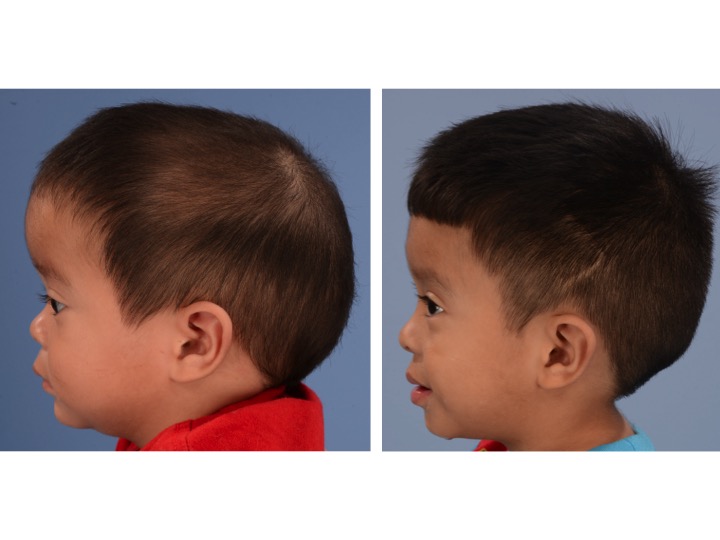 The picture on the left shows the same infant with sagittal synostosis demonstrating significant compensatory growth of the forehead. The image on the right shows the same patient 2 years after surgery.
