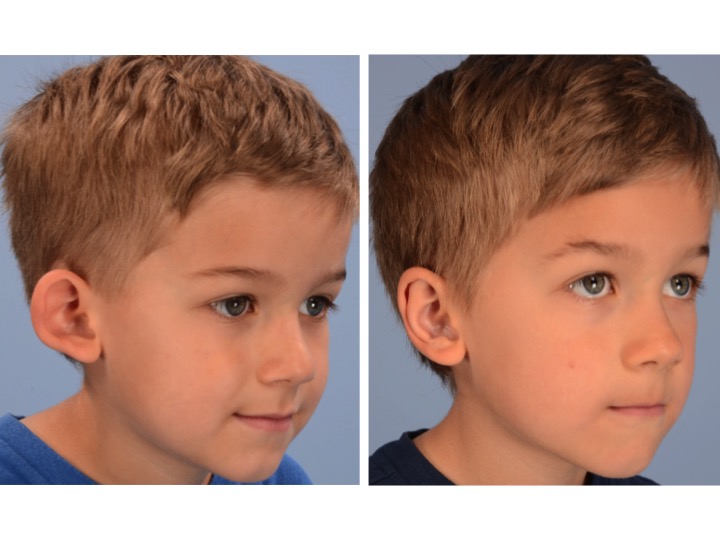 The preoperative image on the left side of this figure shows loss of the finer features of the ear because of the abnormal forward projection and cupping of the ear. The postoperative image on the right demonstrates restoration of the normal dimensions, projection and delicate features of the ear with a natural appearance.