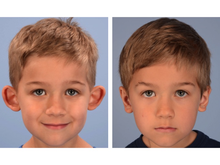 Derderian Otoplasty Case 1 AP