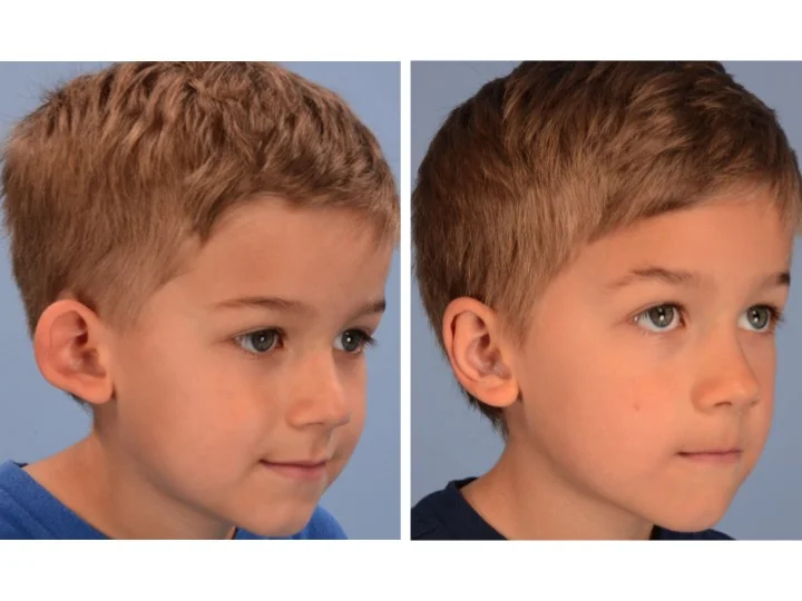 Derderian Otoplasty Case 1 Right 3/4