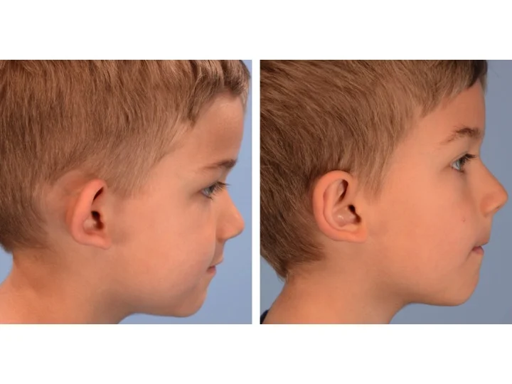 Derderian Otoplasty Case 1 Right Lateral