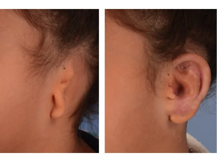 drderderian.com Ear Reconstruction Case 3 Left 3/4 View