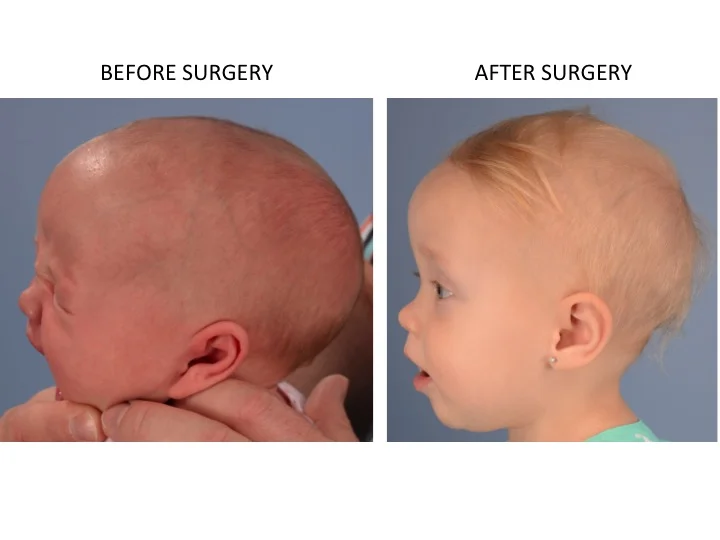 drderderian.com Minimally Invasive Sagittal Strip Craniectomy Case 5 Lateral View