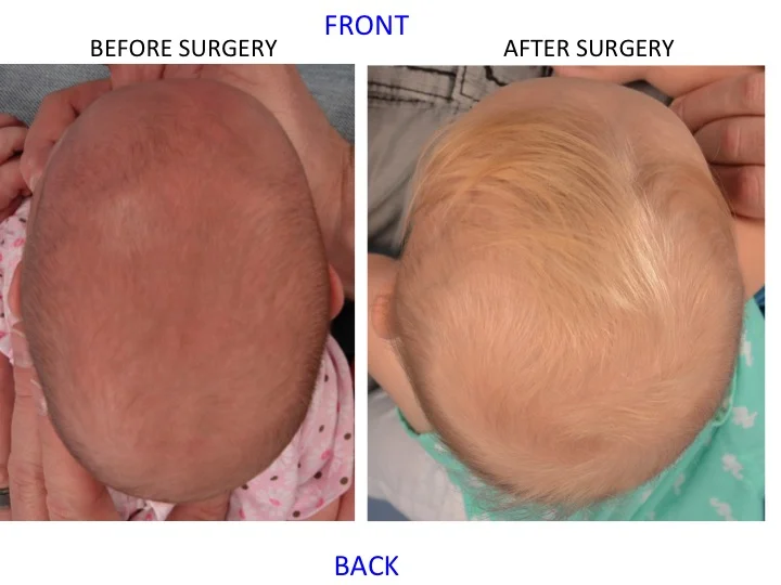 drderderian.com Minimally Invasive Sagittal Strip Craniectomy Case 5 Top Down View