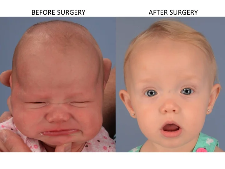drderderian.com Minimally Invasive Sagittal Strip Craniectomy Case 5 AP View