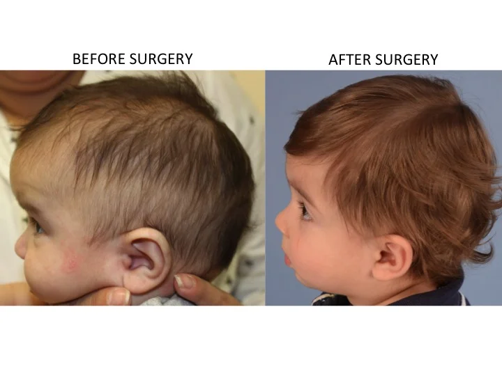drderderian.com Minimally Invasive Sagittal Strip Craniectomy Case 11 Lateral View
