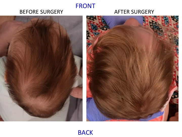 drderderian.com Minimally Invasive Sagittal Strip Craniectomy Case 13 Top Down View