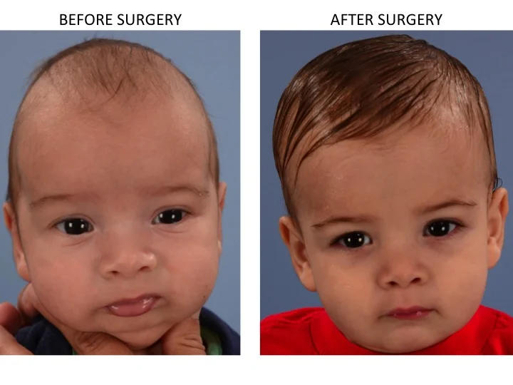 drderderian.com Minimally Invasive Sagittal Strip Craniectomy Case 1 AP